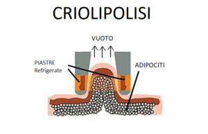 criolipolisi come funziona